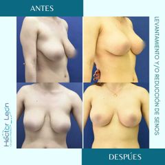 Mamoplastia de reducción - Dr. Héctor Guillermo León Higuera