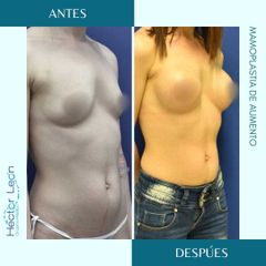 Mamoplastia de aumento - Dra. Daniela Stephania Vaca Grisales