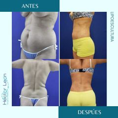 Liposucción - Dr. Héctor Guillermo León Higuera