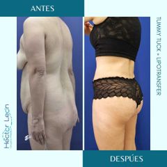 Gluteoplastia - Dr. Héctor Guillermo León Higuera