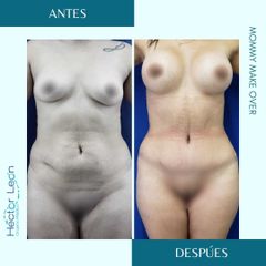 Lipoescultura - Dr. Héctor Guillermo León Higuera