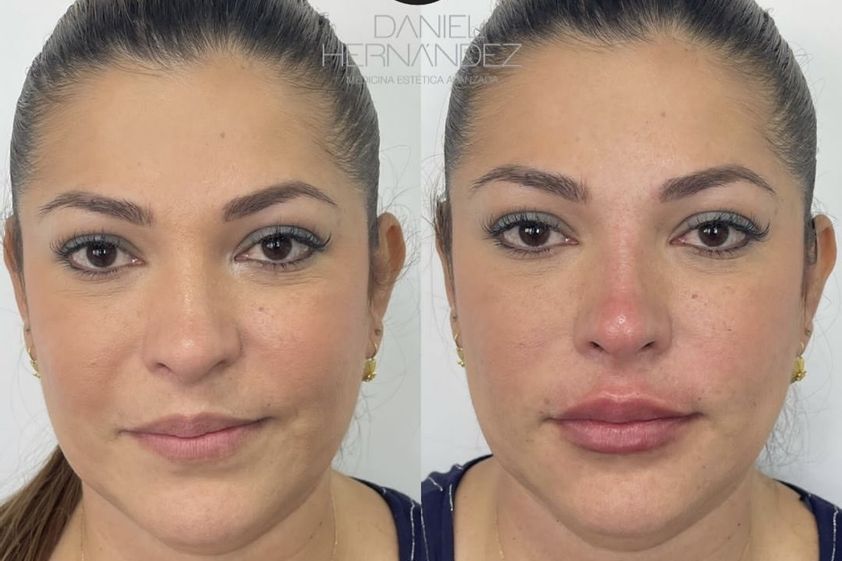 Aumento de labios antes y después - 830212
