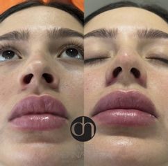 Aumento de labios - Dr. Daniel Hernández