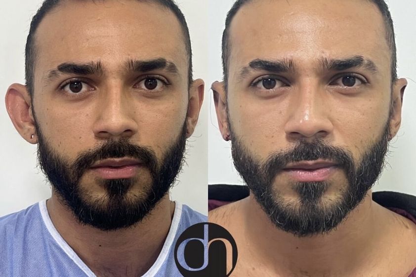 Otoplastia antes y después - 830223