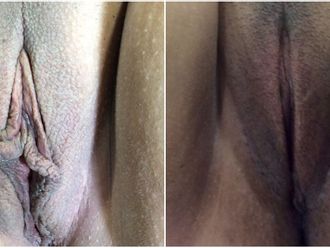 Labioplastia antes y después - 843732