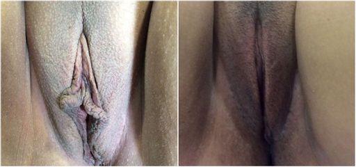Labioplastia - Cirugía Intima Dr. Jorge Mario Mejía Restrepo