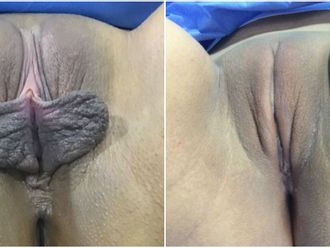 Labioplastia antes y después - 843733