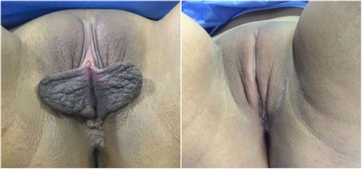 Labioplastia - Cirugía Intima Dr. Jorge Mario Mejía Restrepo