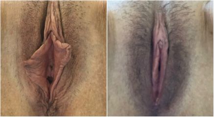 Labioplastia - Cirugía Intima Dr. Jorge Mario Mejía Restrepo