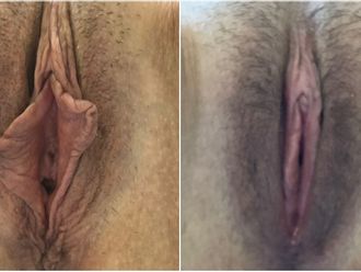 Labioplastia antes y después - 843737