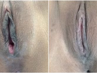 Labioplastia antes y después - 843739