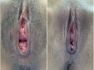 Vaginoplastia antes y después - 843742
