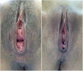 Vaginoplastia - Cirugía Intima Dr. Jorge Mario Mejía Restrepo