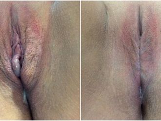 Vaginoplastia antes y después - 843743