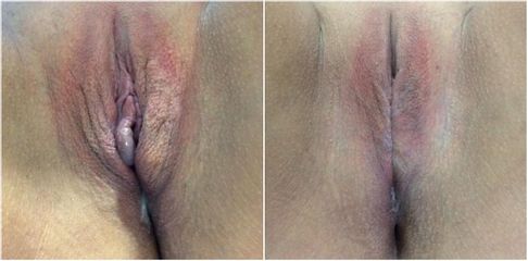 Vaginoplastia - Cirugía Intima Dr. Jorge Mario Mejía Restrepo