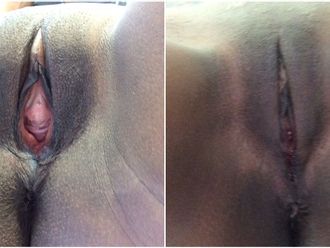 Vaginoplastia antes y después - 843744