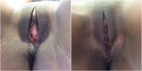 Vaginoplastia - Cirugía Intima Dr. Jorge Mario Mejía Restrepo
