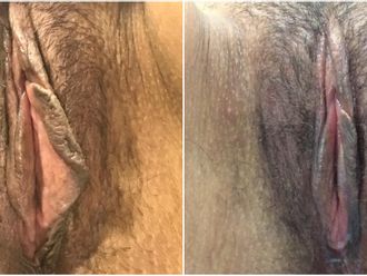 Labioplastia antes y después - 843745