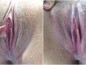 Labioplastia antes y después - 843746