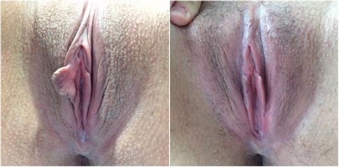 Labioplastia - Cirugía Intima Dr. Jorge Mario Mejía Restrepo