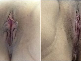 Labioplastia antes y después - 843747