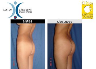 Gluteoplastia