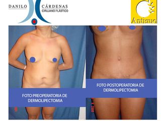 Dermolipectomía