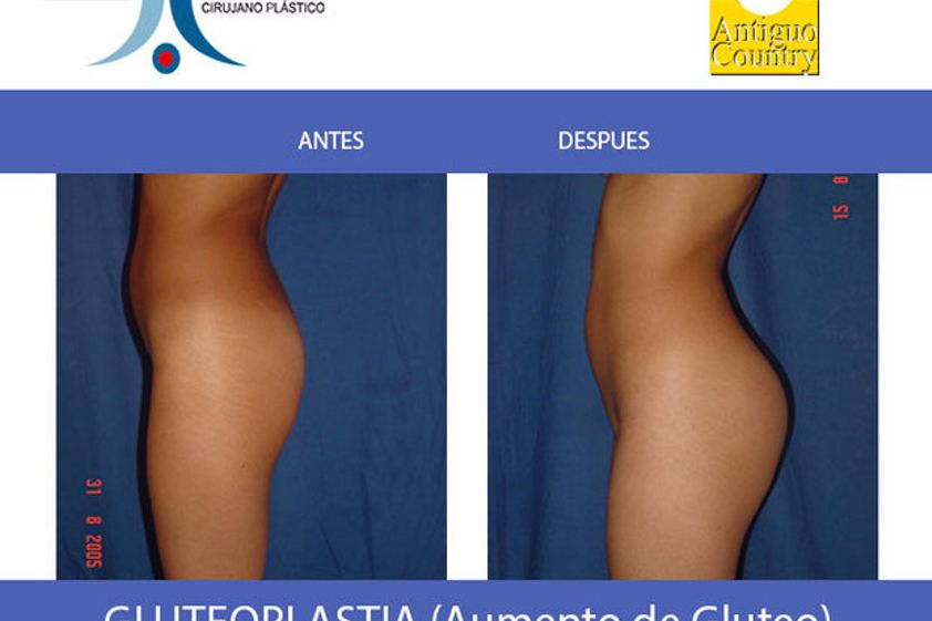 Levantamiento de glúteos antes y después - 483873