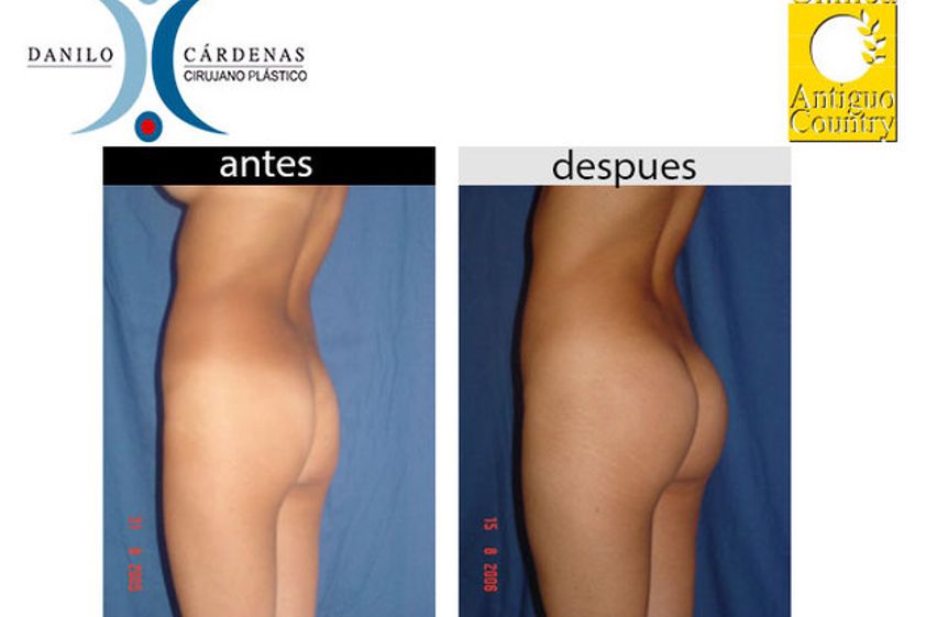 Levantamiento de glúteos antes y después - 483874