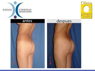 Gluteoplastia