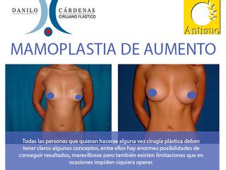 Mamoplastia de Aumento