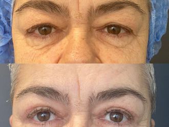 Blefaroplastia antes y después - 870498