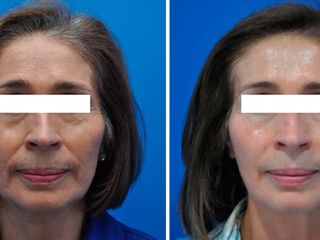 Antes y despues de estiramiento facial no quirurgico