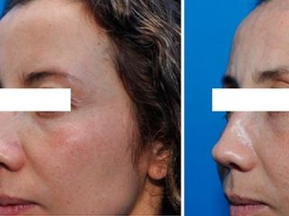 Antes y despues de estiramiento facial no quirurgico