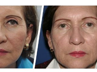 Antes y depsues de laser para mejorar el aspecto de la piel