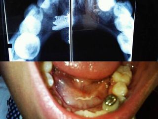 Ránula, Patología oral