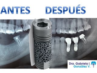 IMPLANTES DENTALES METAL TRABECULADO