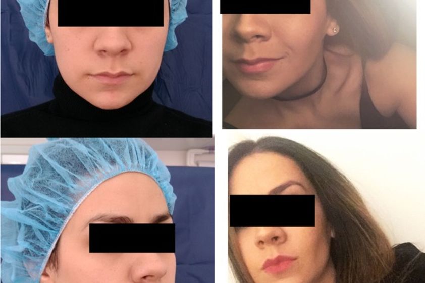 Cirugía maxilofacial antes y después - 613077