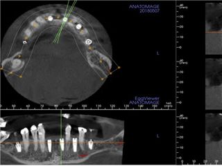 TOMOGRAFÍA COMPUTARIZADA IMPLANTES DENTALES