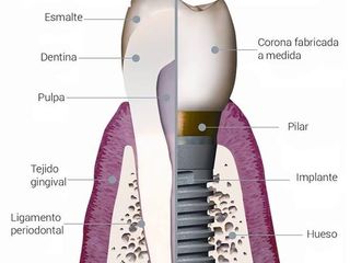 DIENTE E IMPLANTE DENTAL