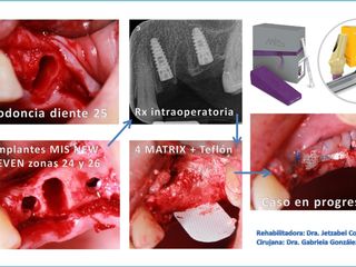 Implantes dentales Dra Gabriela González