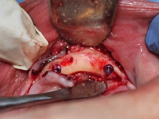 Implantes dentales Dra Gabriela González