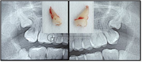 Terceros molares / Cordales - Dra. Gabriela Isabel González Víquez