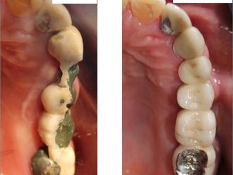 Implantes dentales - 702510