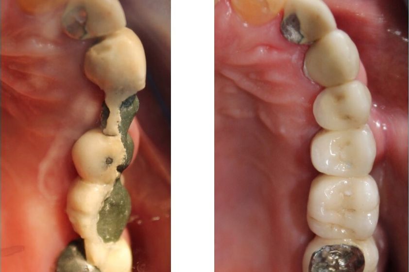 Implantes dentales antes y después - 702510