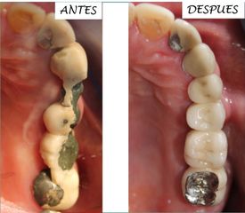 Prótesis dental - Dra. Gabriela Isabel González Víquez