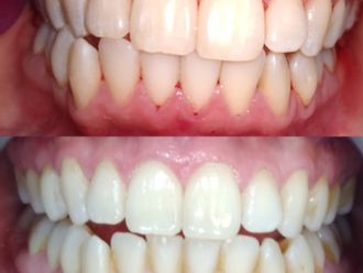Blanqueamiento dental - 740722
