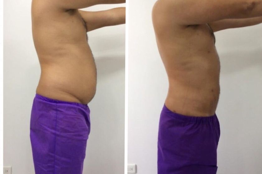 Mesoterapia antes y después - 696229