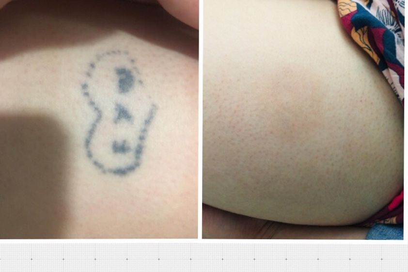 Borrar tatuajes antes y después - 698170