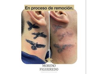 Borrar tatuajes - 844310